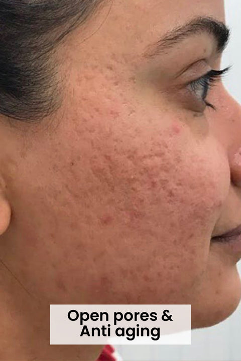 Open Pores and Anti Aging