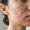 Active Acne & Redness