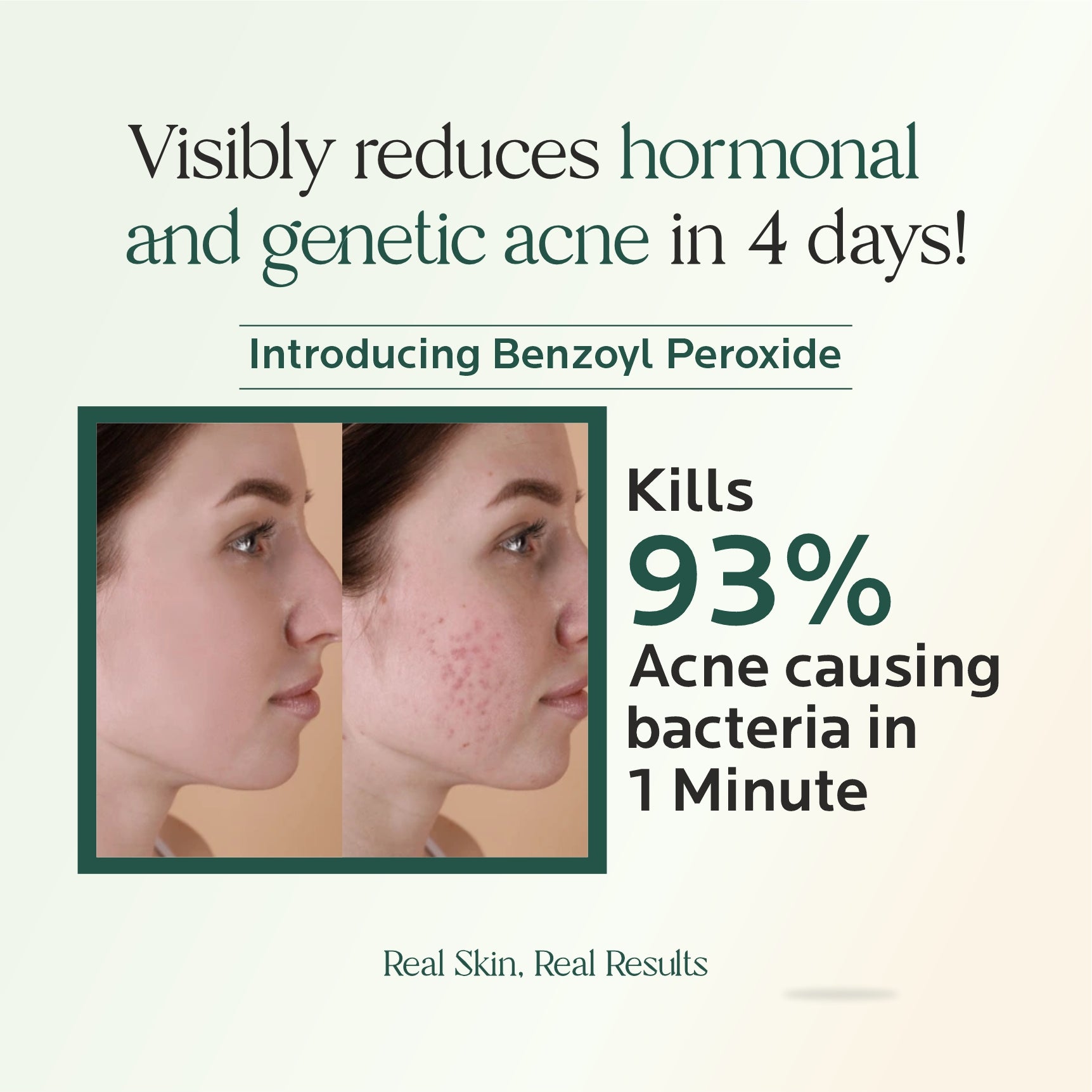 Hormonal Acne