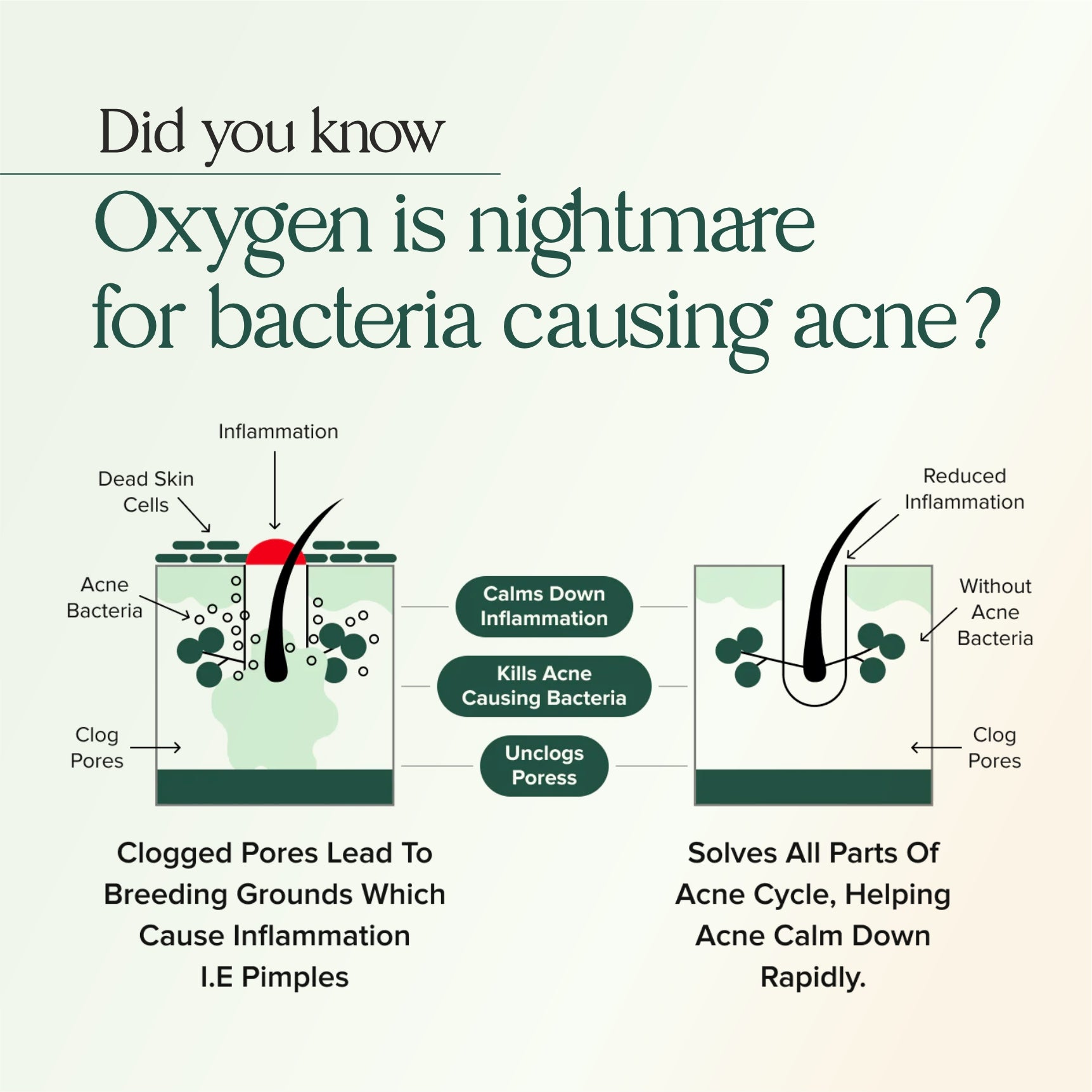 Hormonal Acne