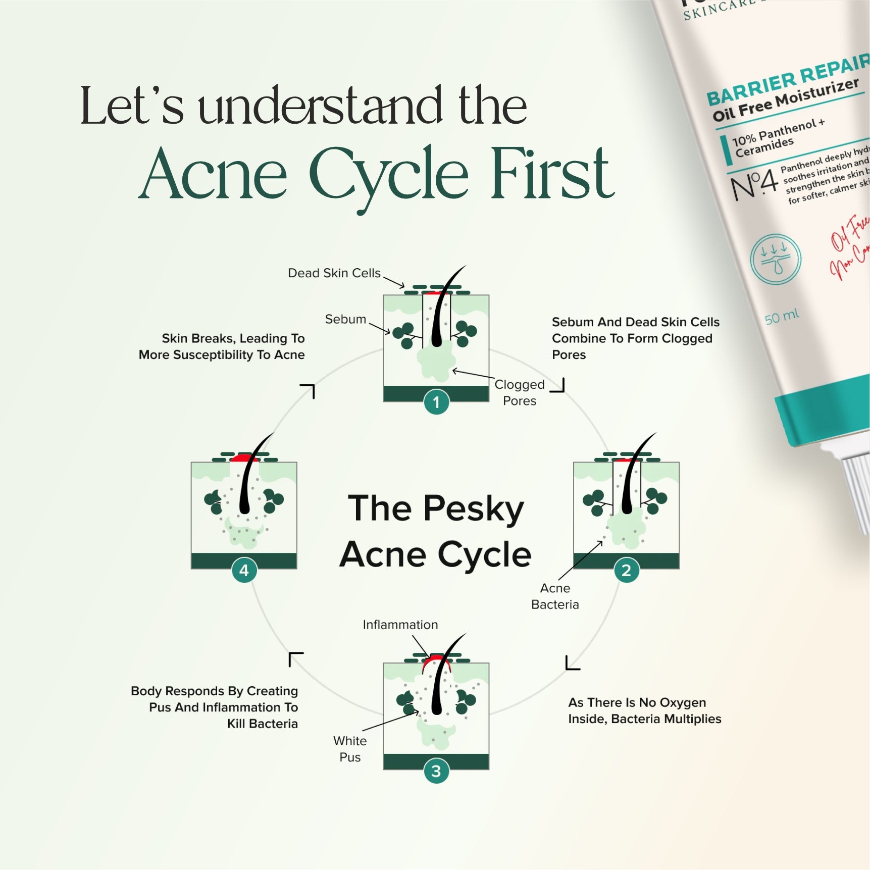 Hormonal Acne