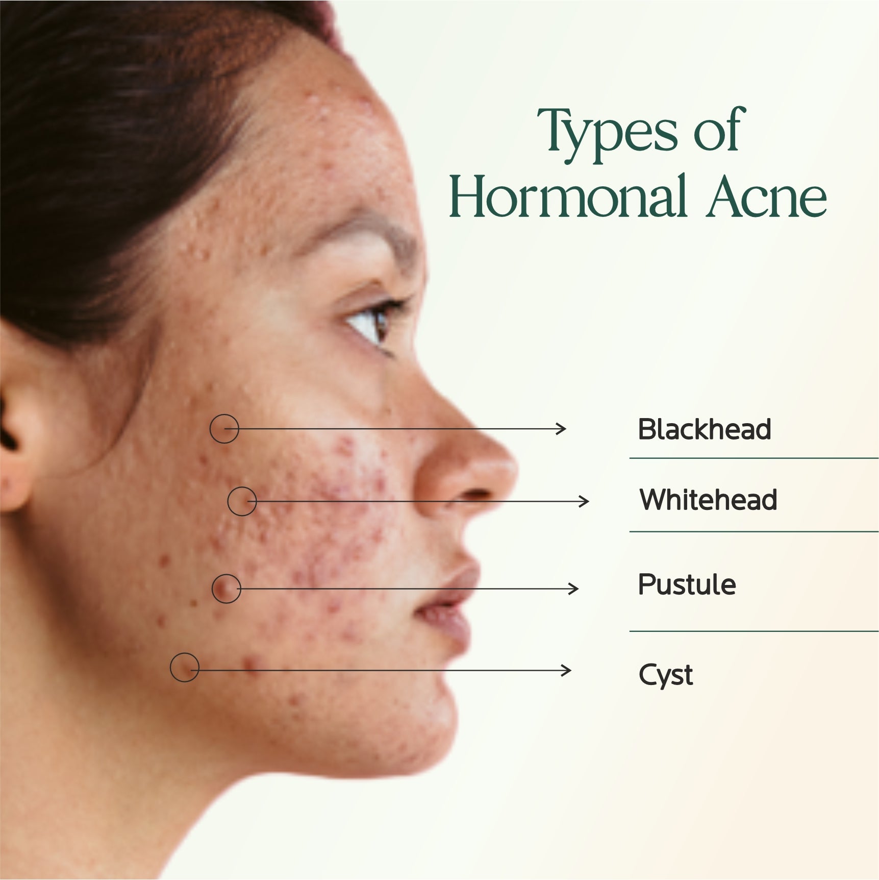 Hormonal Acne