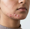 Hormonal/Cystic Acne