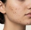Post-Acne Marks
