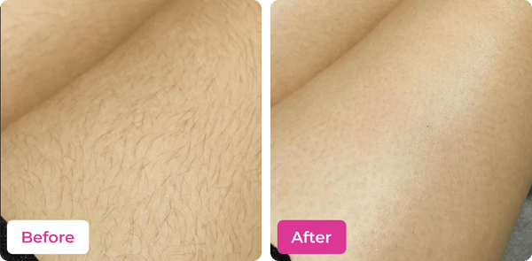 Meeoow Club Hair Removal Powder before and after results on legs