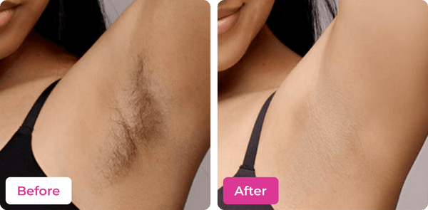 Before and after underarm hair removal results with Meeoow Club Bikini Wax Powder