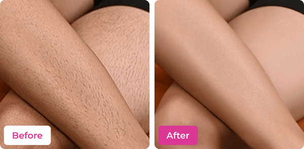 Meeoow Club Hair Removal Powder before and after results on legs