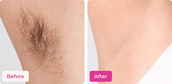 Meeoow Club Hair Removal Powder before and after results on underarms