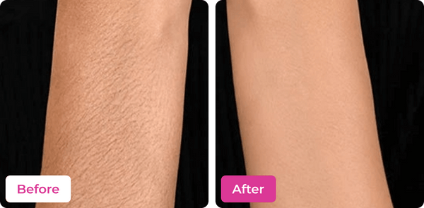 Before and after arm hair removal results using Meeoow Club 10 Min Painless Wax Powder
